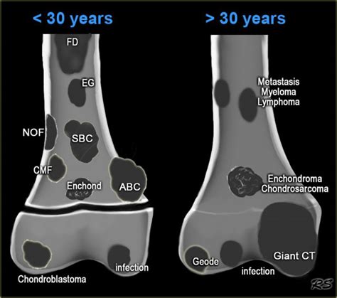 lytic bone lesion radiology.